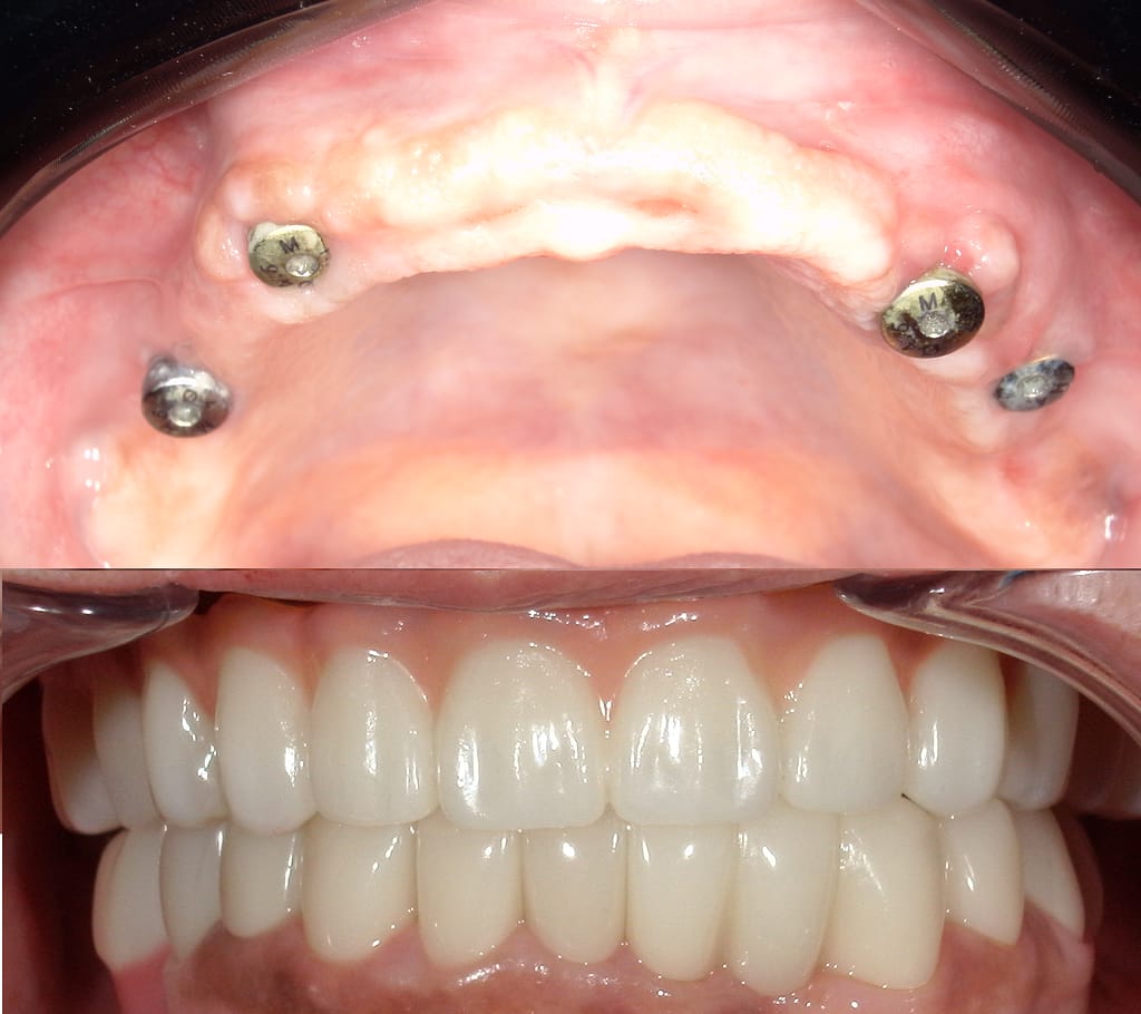 Before and after picture of patient before and after full arch dental implant