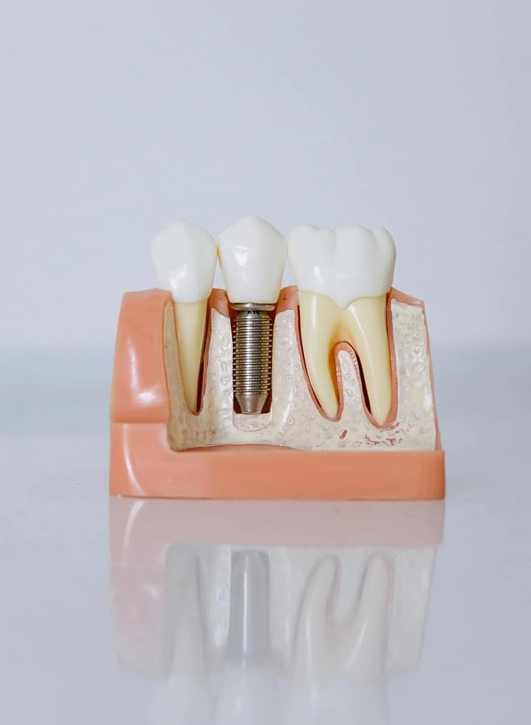 Detailed view of a dental implant model showcasing teeth and gum anatomy for dental education.